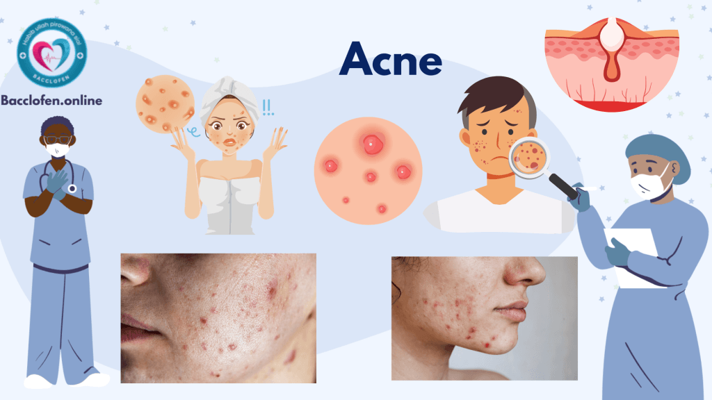 Acne: Causes, Symptoms, Prevention, Diagnosis, and Treatment