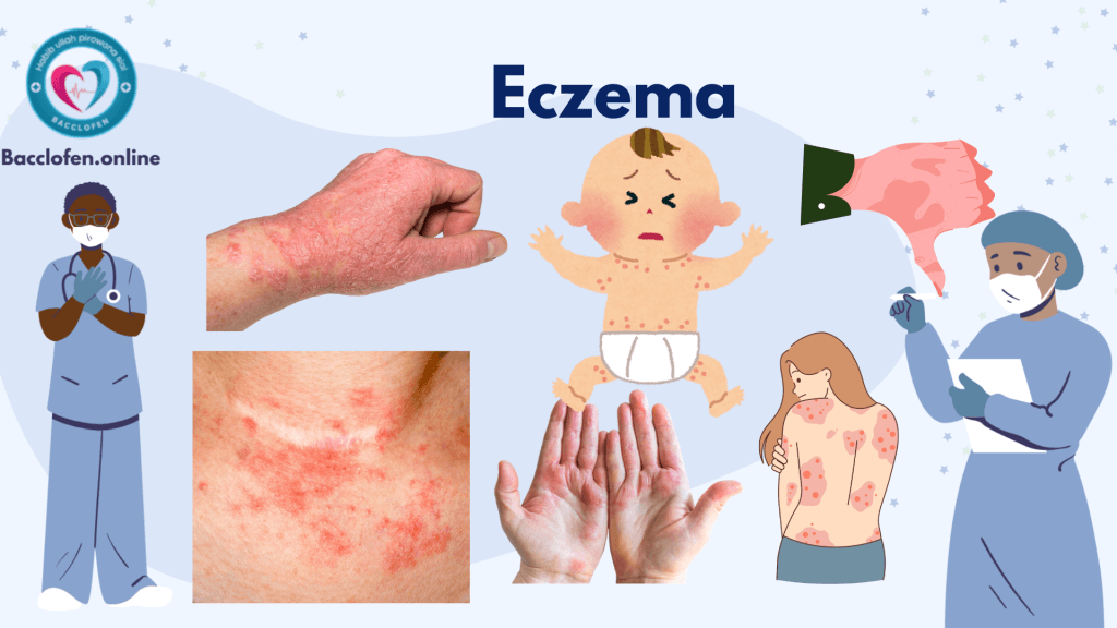 Eczema: Causes, Symptoms, Prevention, Diagnosis, and Treatment