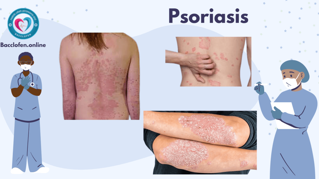 Psoriasis: Causes, Symptoms, Prevention, Diagnosis, and Treatment
