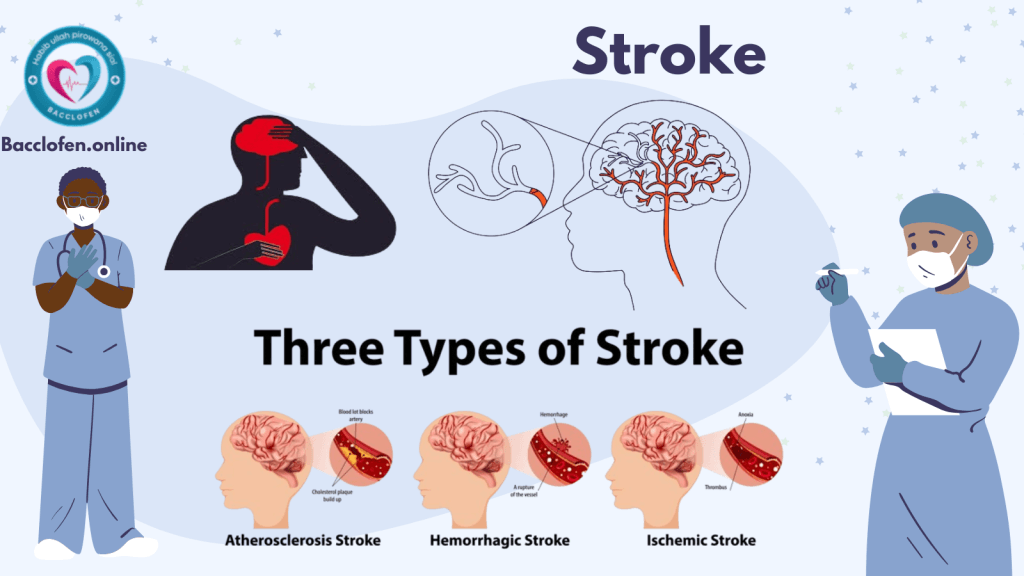 Stroke: Causes, Symptoms, Prevention, Diagnosis, and Treatment